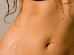 Le terapie antismagliature che fanno bene