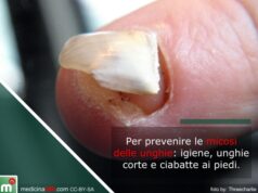 Funghi della pelle, come curarli quando si manifestano